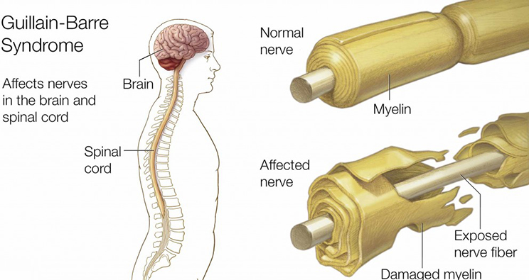 Guillain-Barre Syndrome 